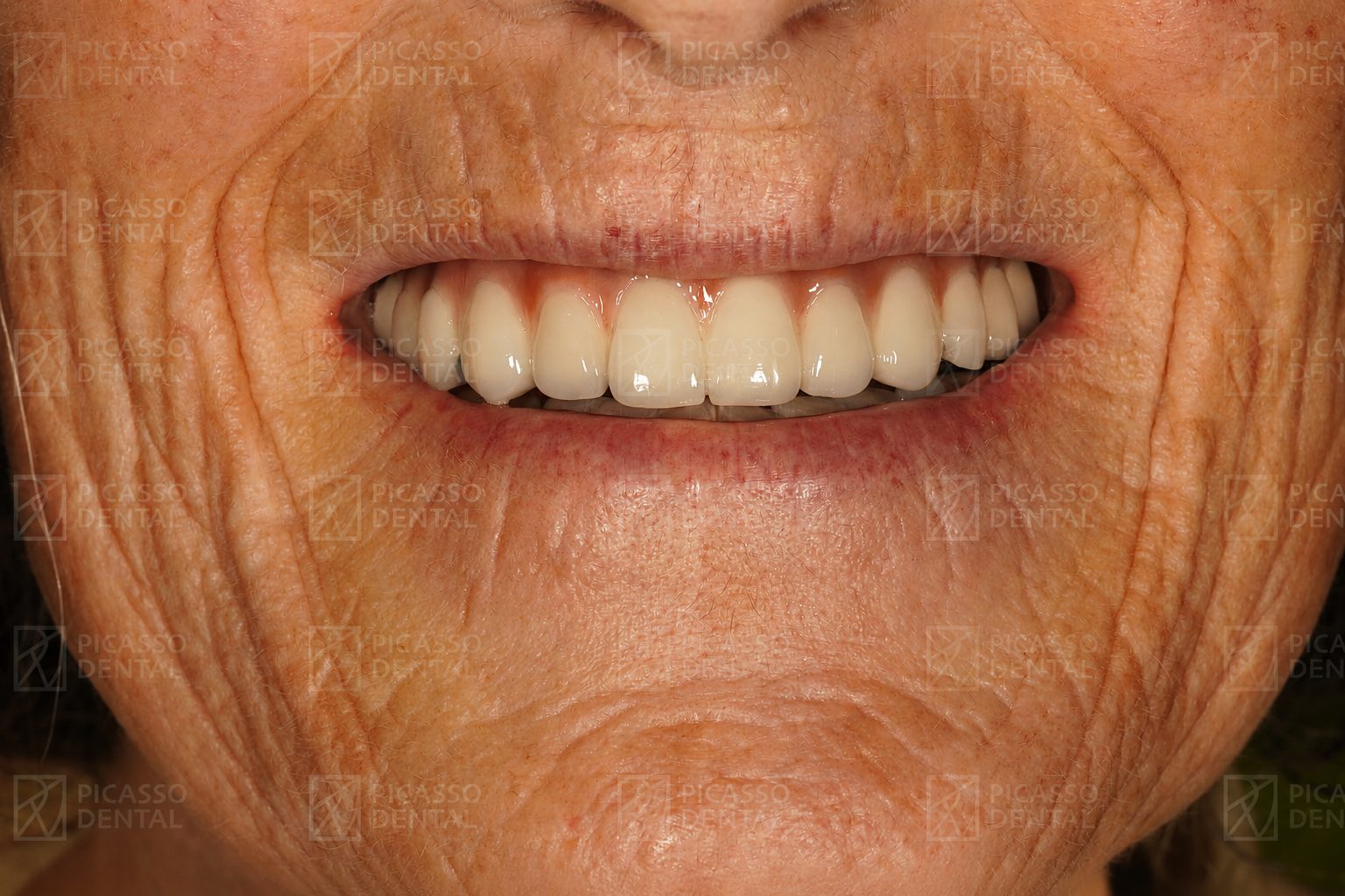 After: All-on-6 upper jaw implants and 3 single implants with zirconia crowns and bridge, Picasso Dental Old Quarter