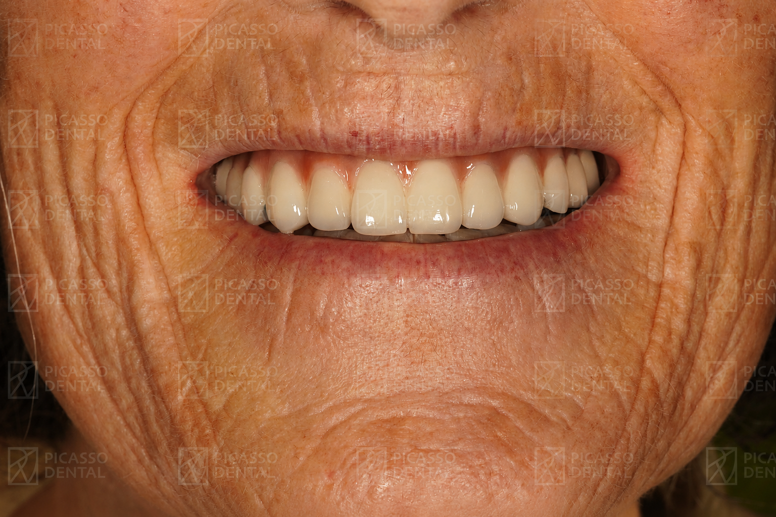 After: All-on-6 upper jaw implants and 3 single implants with zirconia crowns and bridge, Picasso Dental Old Quarter