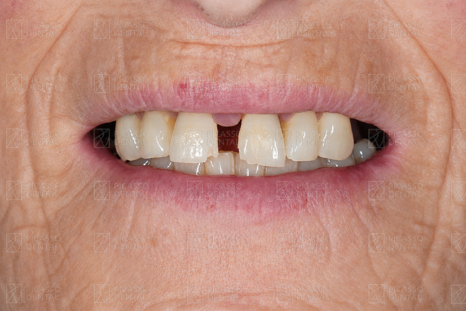 Before: missing and failing upper teeth with gap prior to full-arch implant rehabilitation