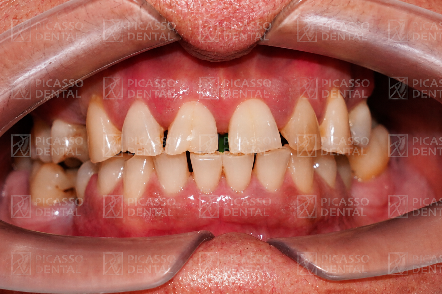 Before: heavily stained, worn and misaligned teeth prior to full-arch crown and veneer treatment