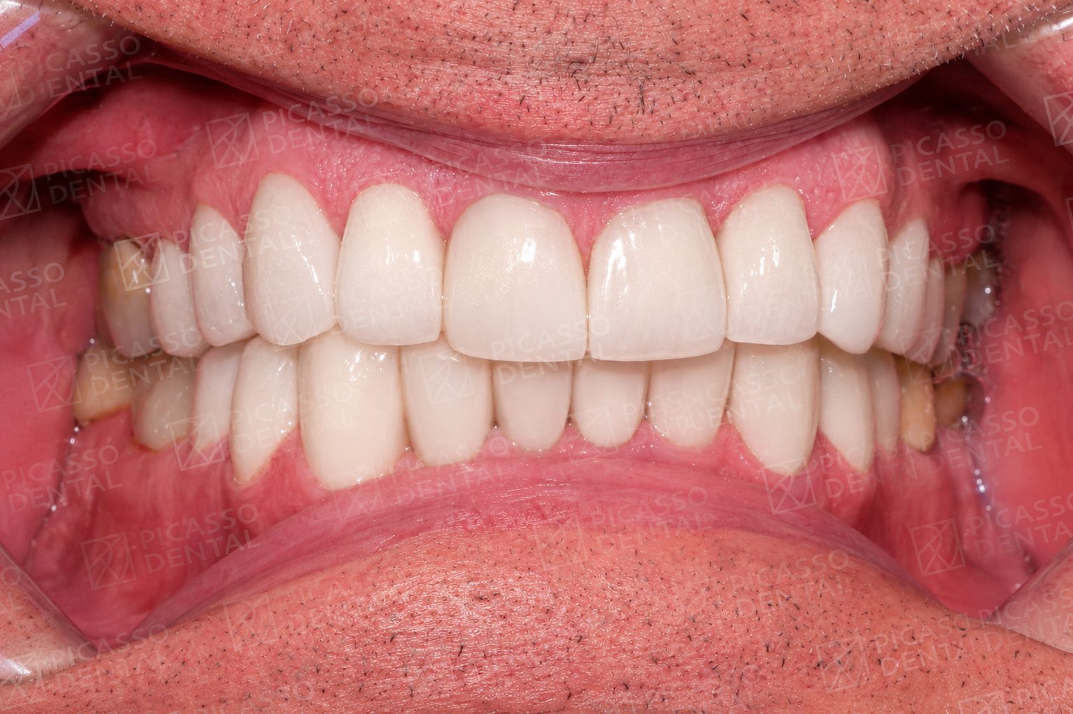 After: 22 LAVA 3M crowns and veneers, 12 upper and 10 lower, Picasso Dental HCMC