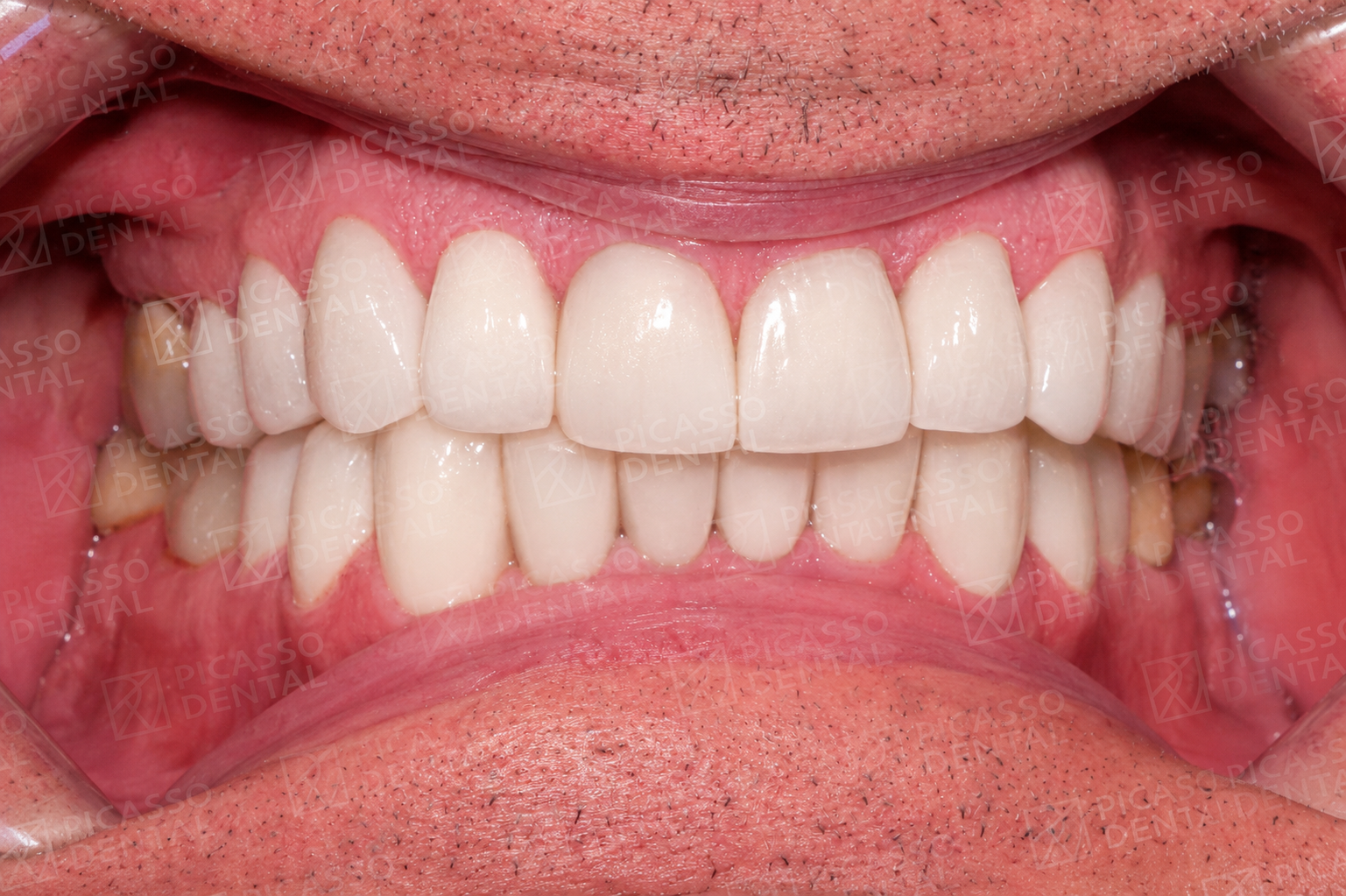 After: 22 LAVA 3M crowns and veneers, 12 upper and 10 lower, Picasso Dental HCMC