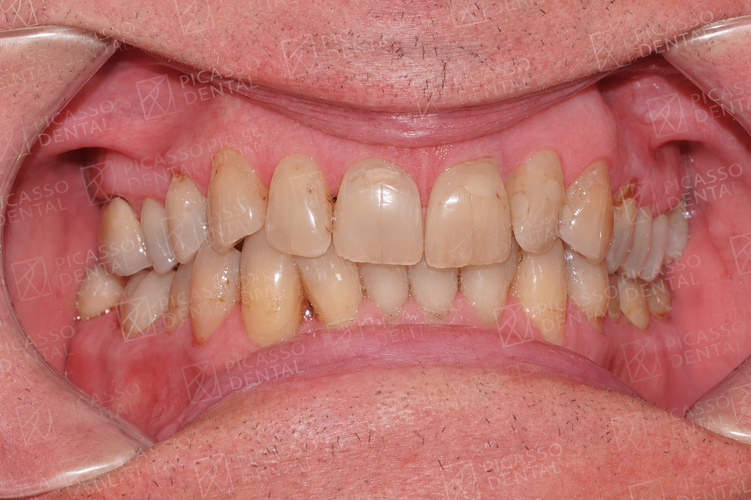 Before: worn, stained and misaligned teeth prior to crown and veneer rehabilitation