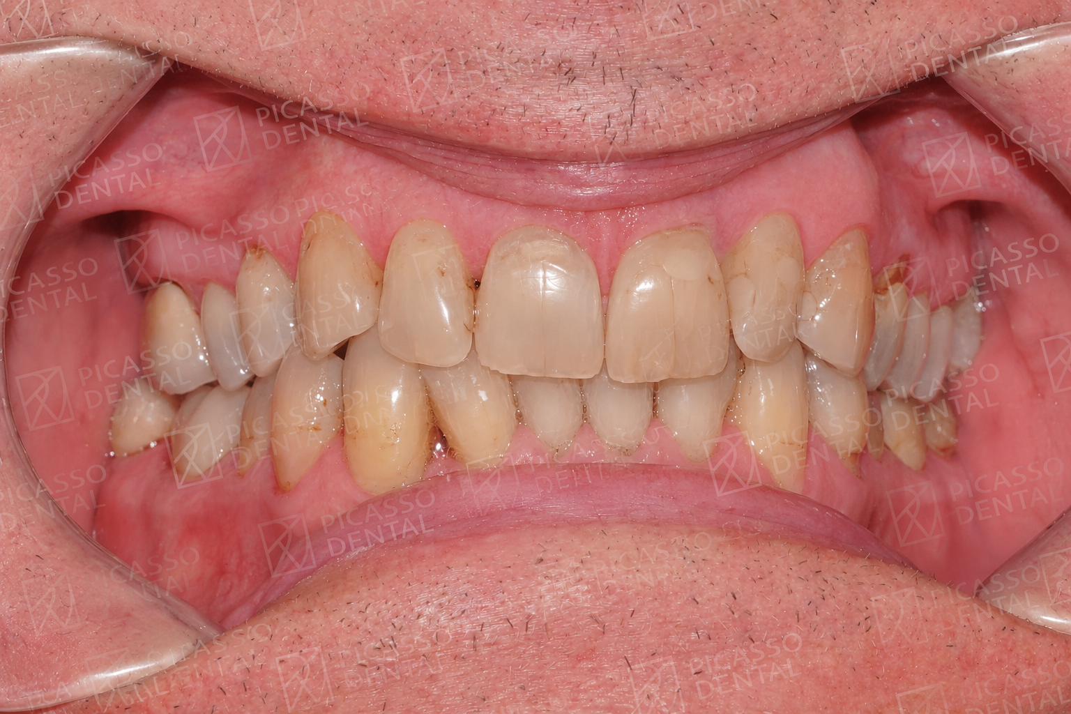 Before: worn, stained and misaligned teeth prior to crown and veneer rehabilitation