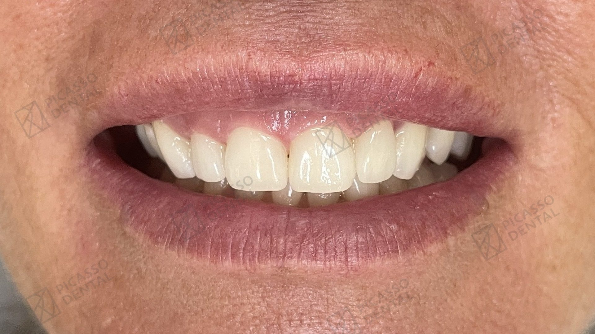 After: 4 composite veneers reshaping upper central and lateral incisors, Picasso Dental Hanoi Old Quarter