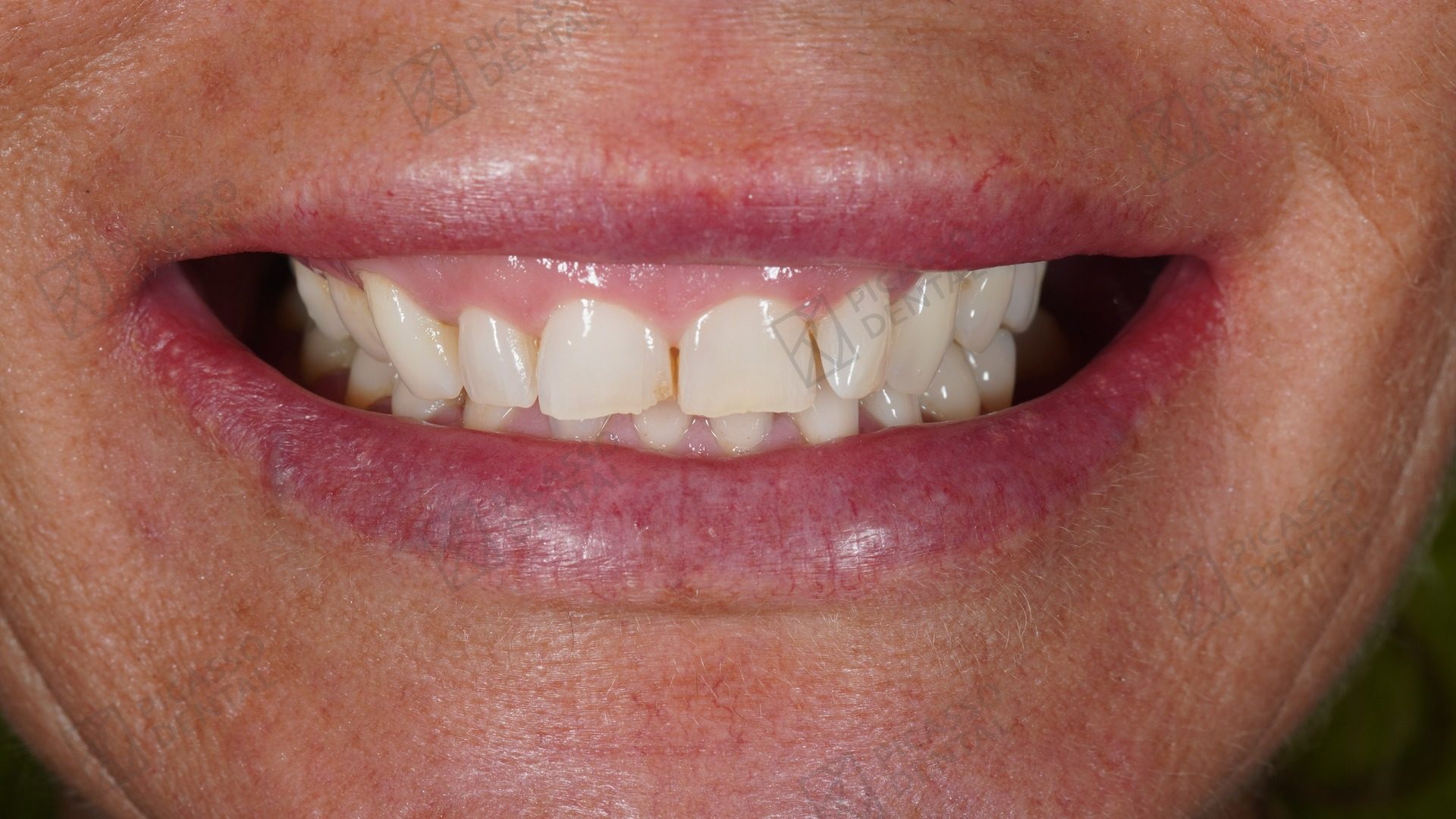 Before: worn and uneven upper incisors with peg-shaped lateral, prior to composite veneer treatment