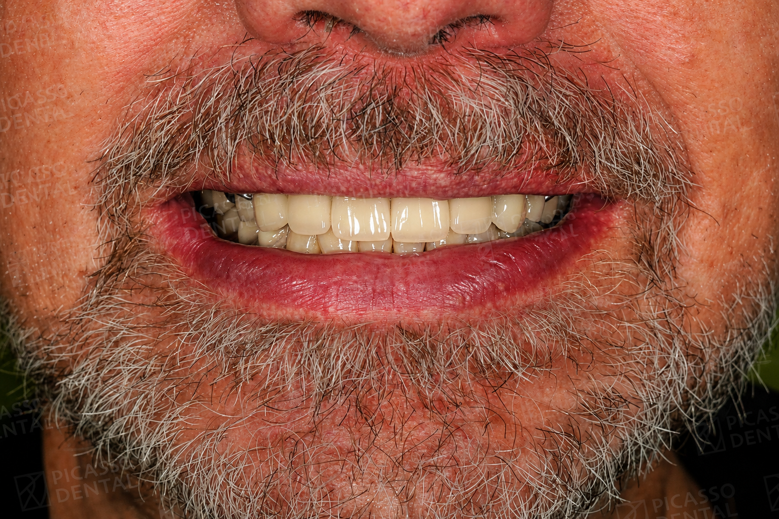After: 12 LAVA 3M crowns with temporary denture, first stage of implant placement