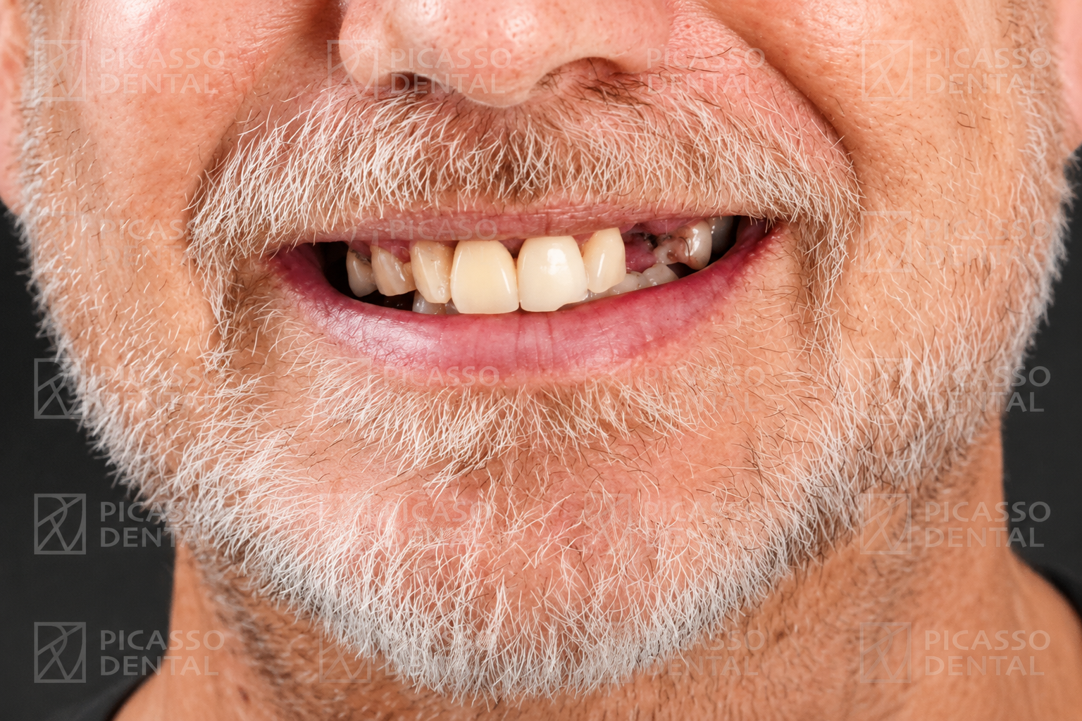 Before: missing and failing teeth prior to crown and implant treatment