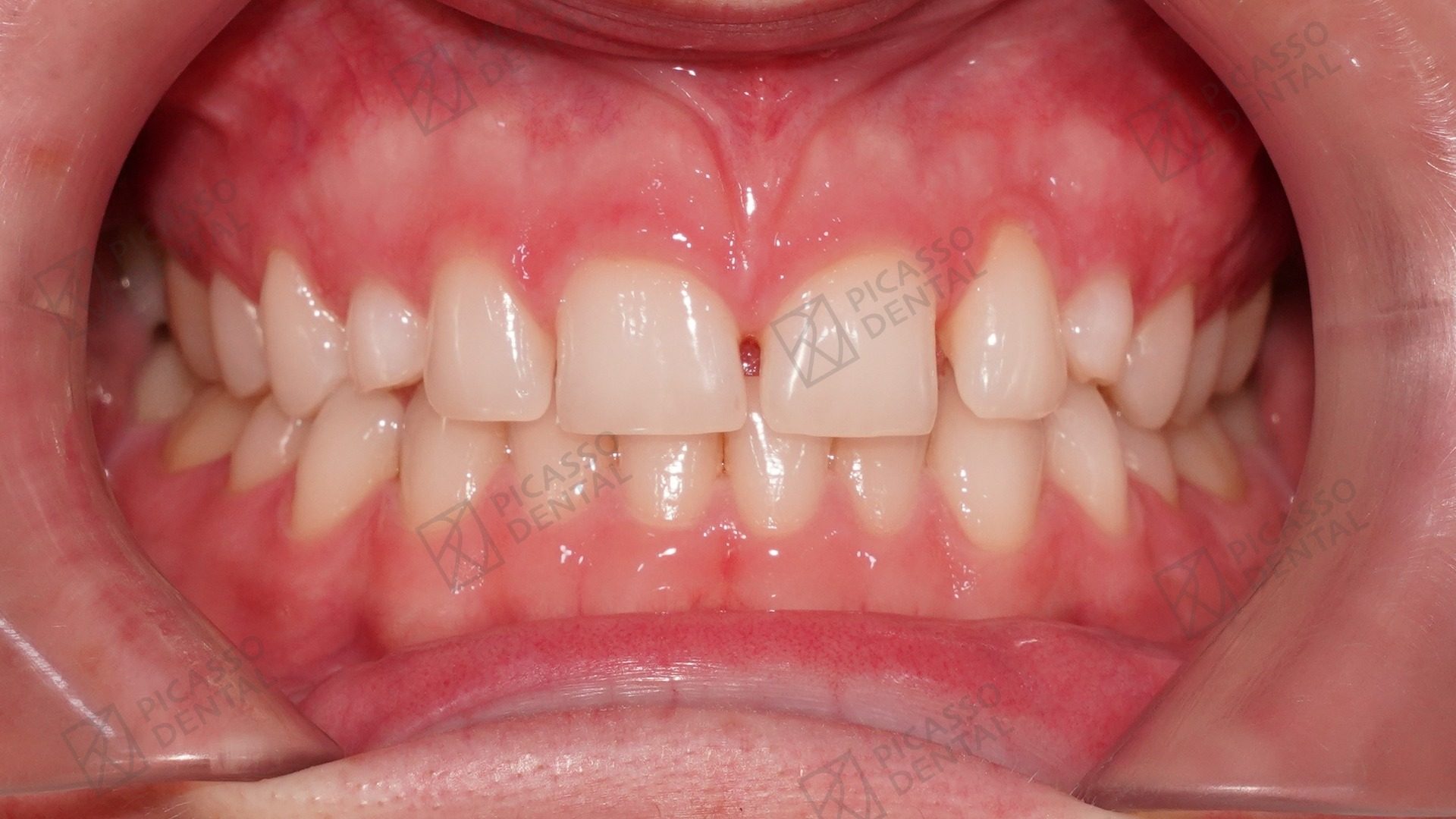 Before: chipped upper central incisor with old composite and uneven edges prior to composite veneer treatment