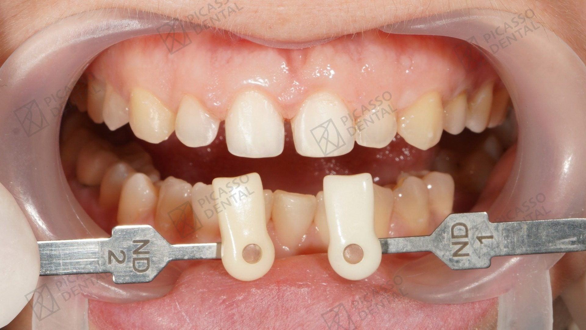 Before: chipped and uneven upper anterior teeth prior to composite veneer rebuild