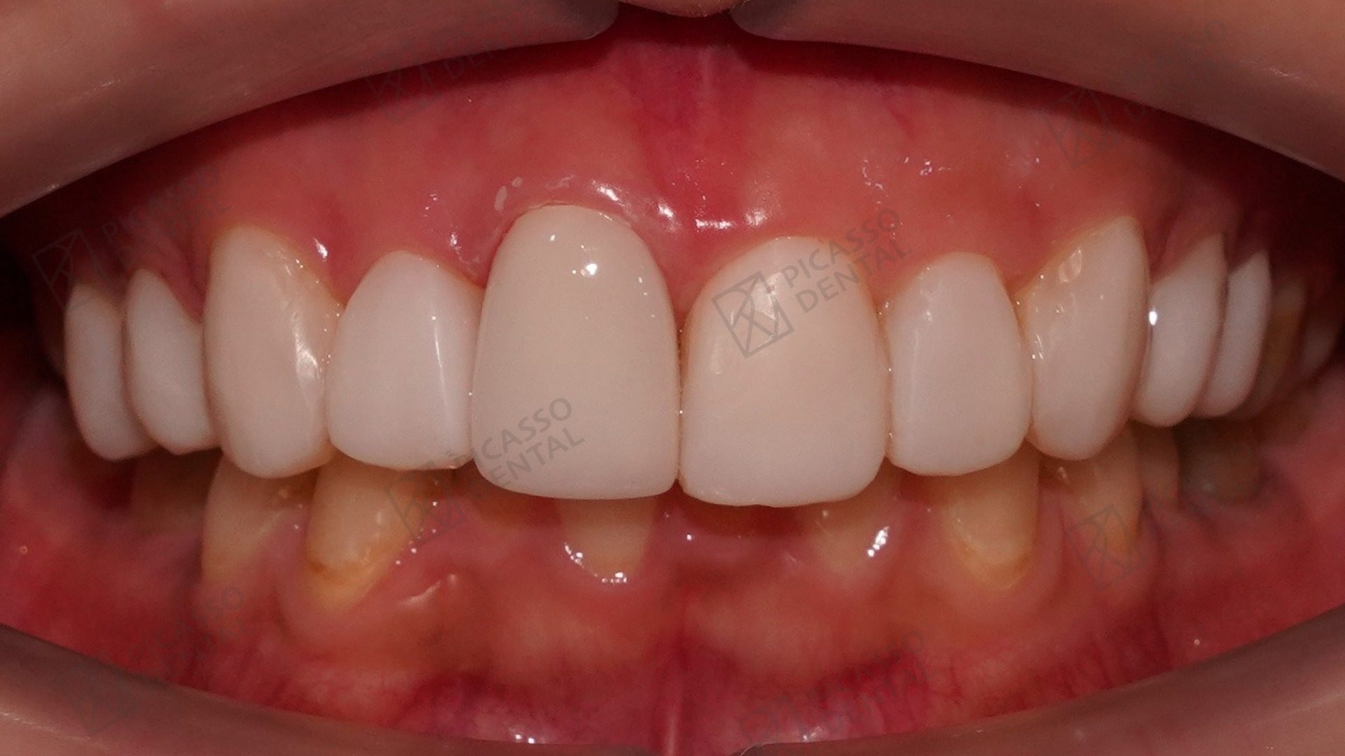 After: composite veneers across upper anteriors with single zirconia crown replacement, Picasso Dental Thao Dien