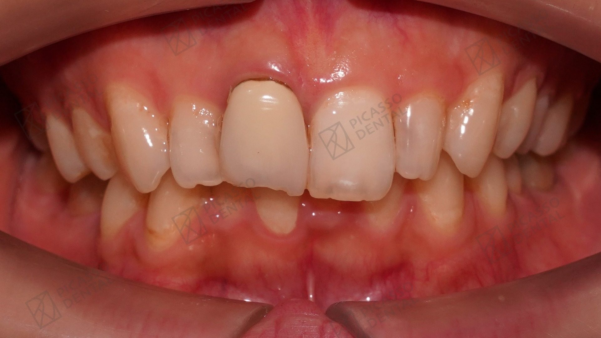 Before: discoloured central incisor with old crown prior to composite veneer and zirconia crown replacement