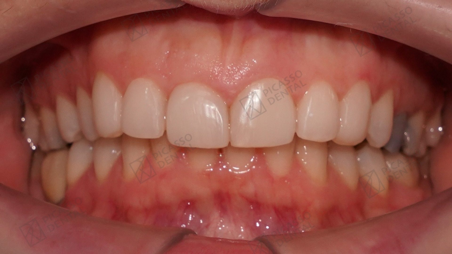 After: 6 composite veneers across upper anteriors with Emax onlay on a posterior tooth, Picasso Dental Thao Dien