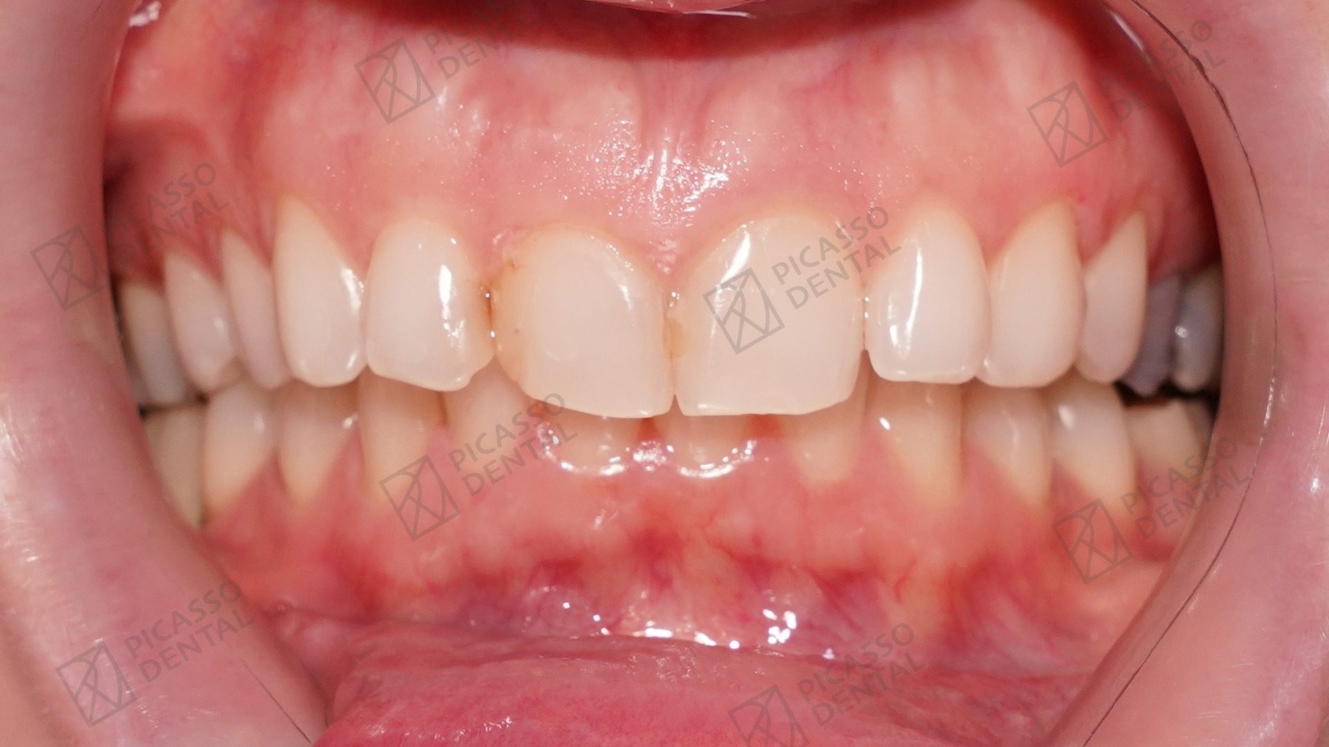 Before: gappy and uneven upper anterior teeth prior to composite veneer treatment