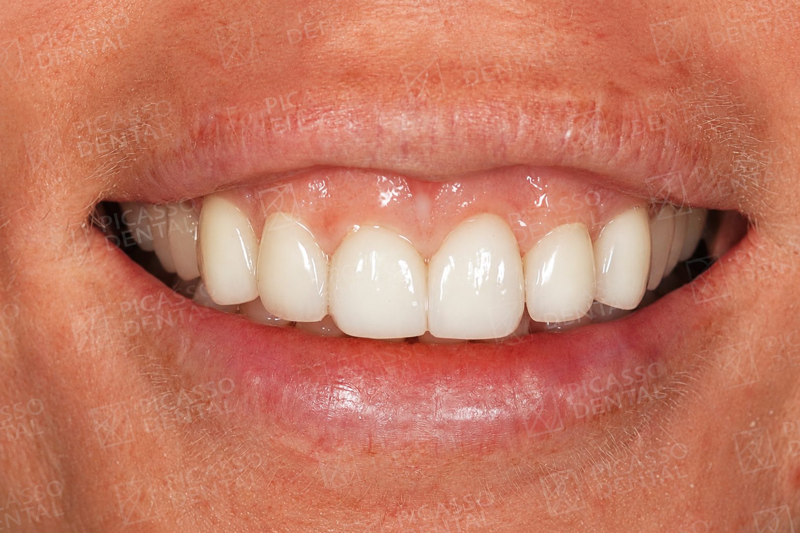 After: 10 Lisi porcelain veneers, upper jaw, Hanoi Old Quarter