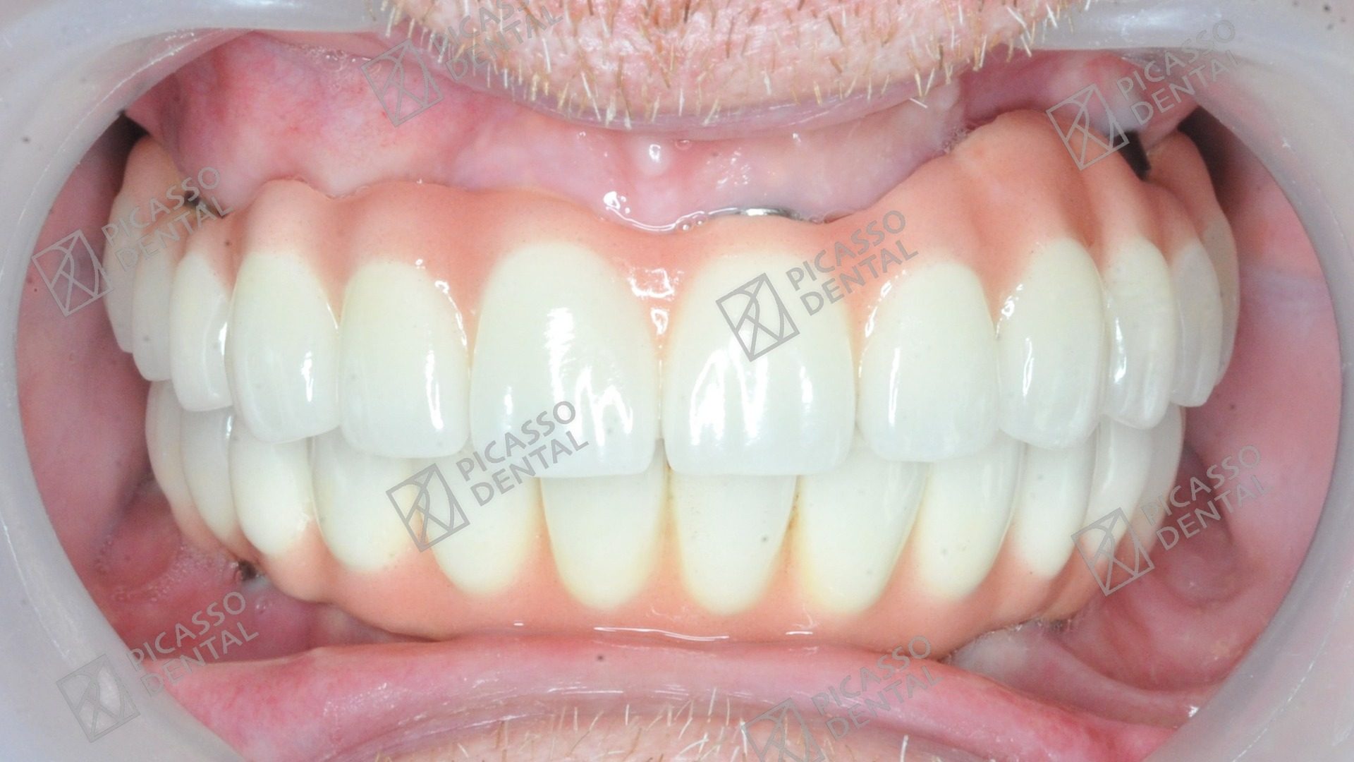 After: full-arch Nobel Biocare All-on-4 implant bridge restoring the upper jaw, Picasso Dental Old Quarter Hanoi