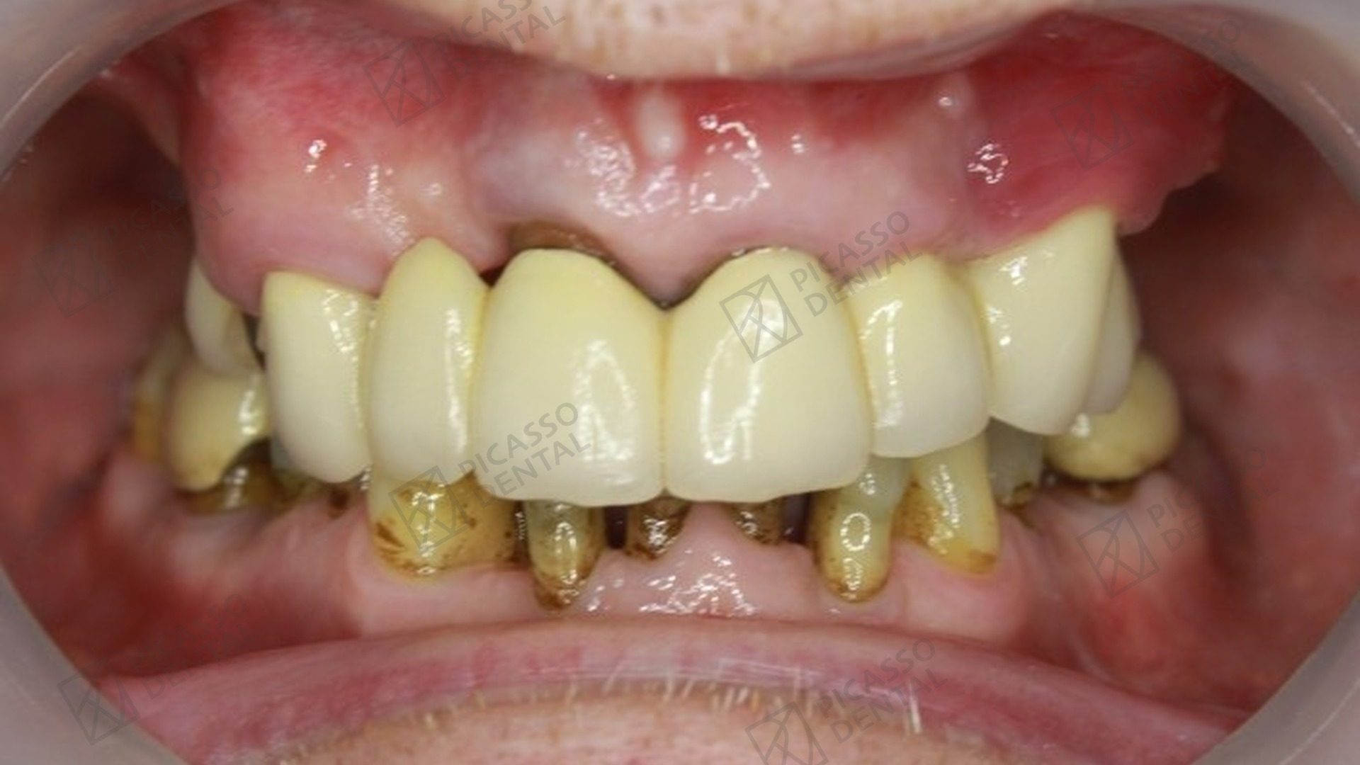 Before: failing upper teeth and gum recession in a 50s patient prior to All-on-4 upper jaw rehabilitation at Picasso Dental