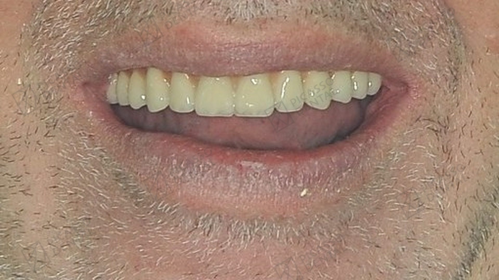 After: full upper and lower All-on-4 Nobel Biocare reconstruction restoring a complete, natural smile, Picasso Dental Old Quarter Hanoi