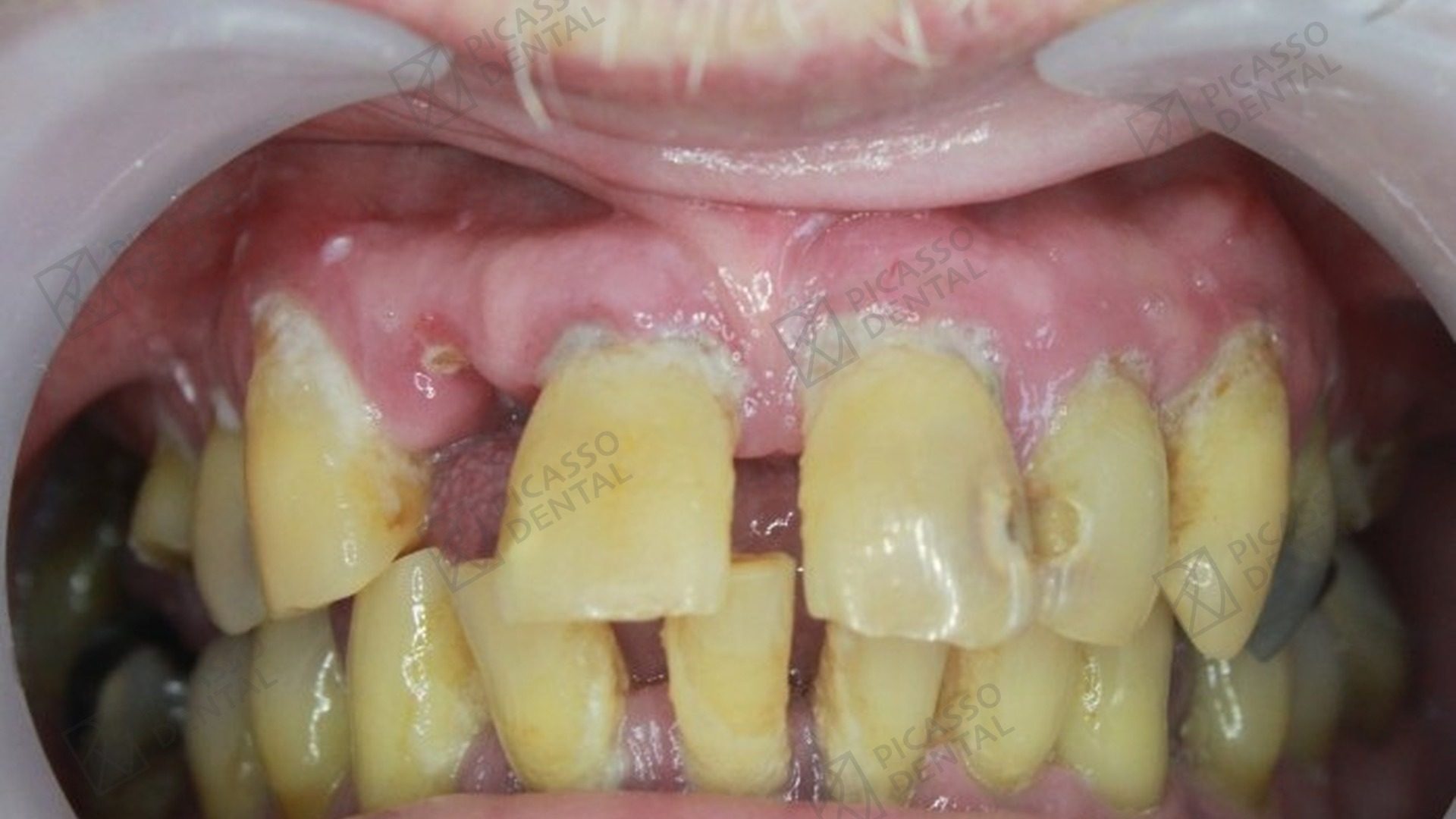 Interim stage: upper jaw All-on-4 bridge in place at Picasso Dental Hanoi Old Quarter, ahead of the second-visit lower jaw rehabilitation