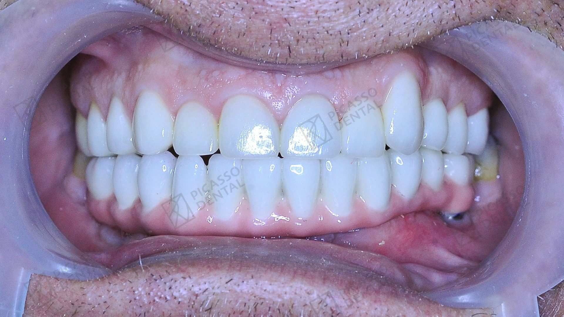 After: clean, evenly aligned upper full-arch Nobel Biocare All-on-4 bridge, Picasso Dental Old Quarter Hanoi