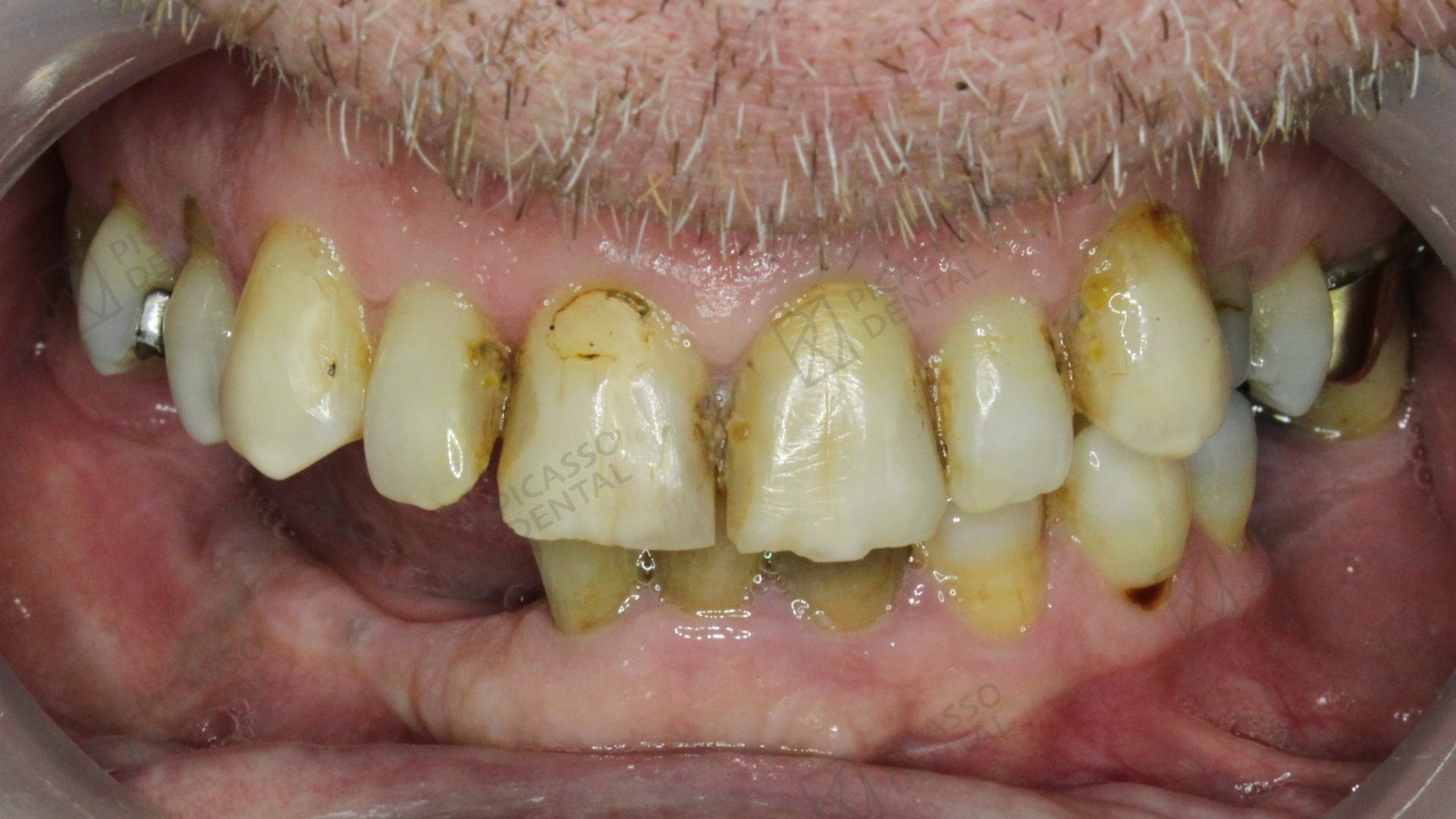 Before: severely worn, decayed and stained upper teeth in a 60s male patient prior to All-on-4 rehabilitation at Picasso Dental
