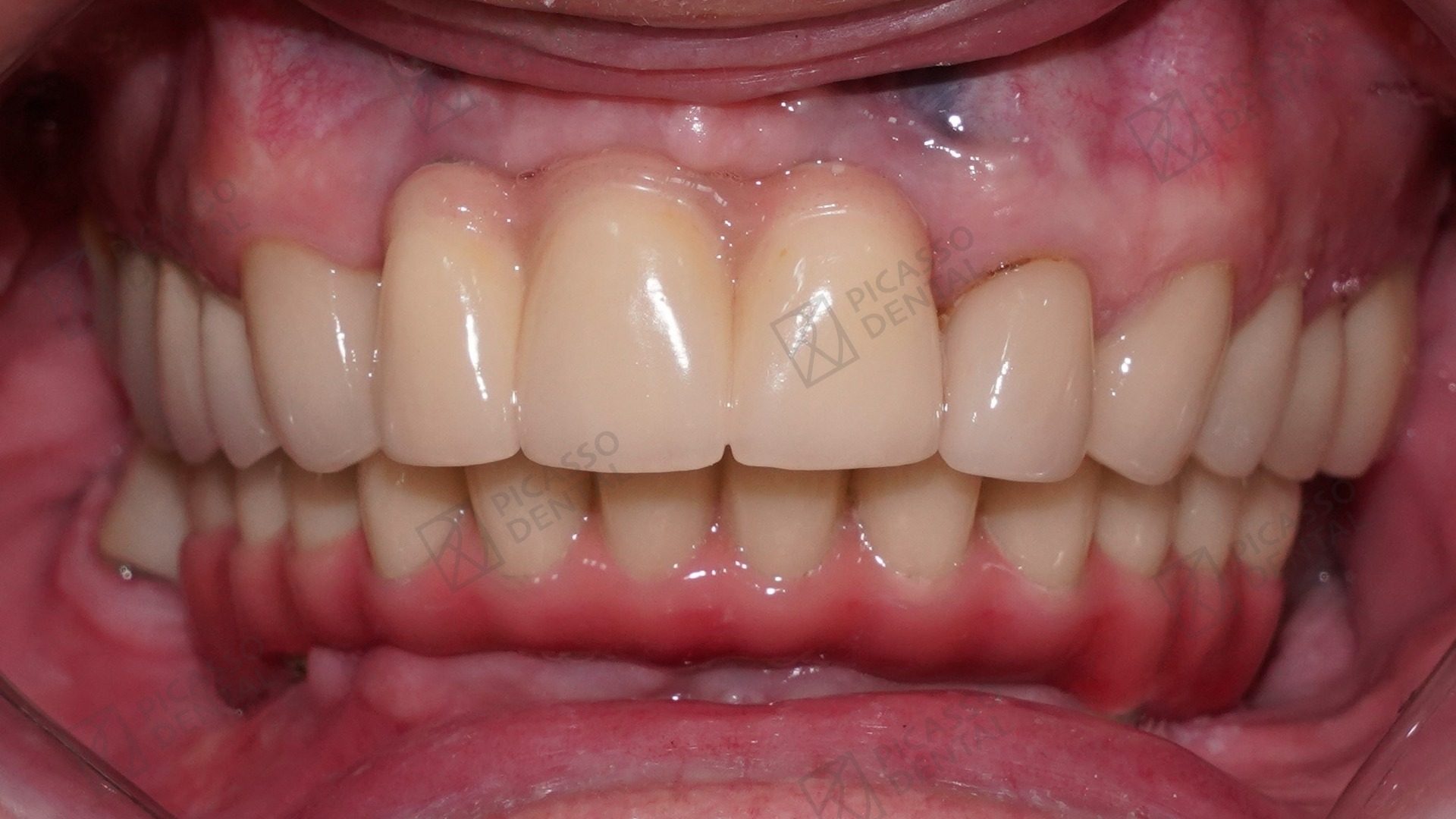 After: complete upper and lower restoration with Nobel Biocare All-on-4 lower bridge plus implant-supported upper crowns, Picasso Dental Thao Dien HCMC