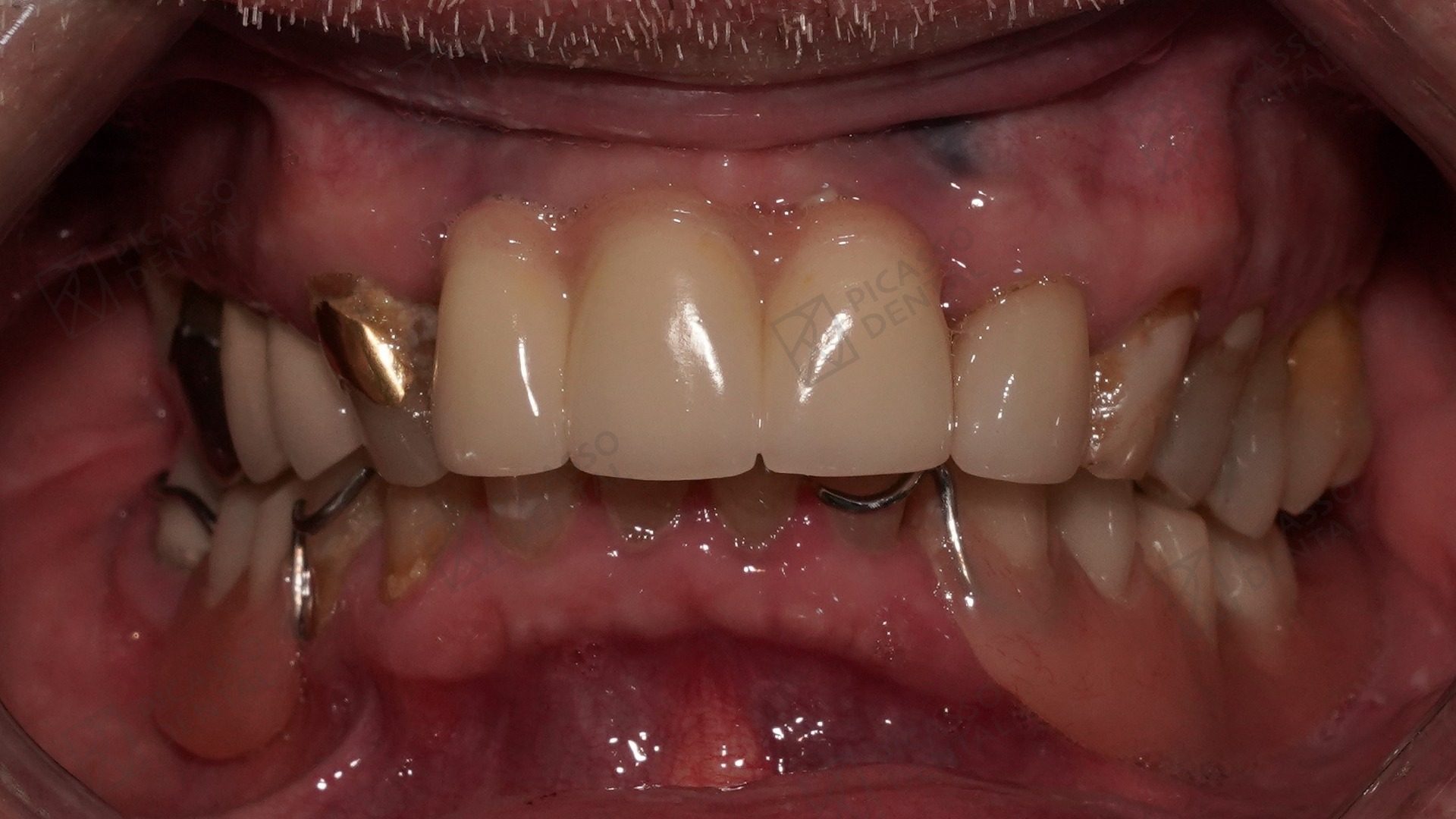Before: failing upper restorations, missing teeth and gold-crowned remnants in a 60s male patient prior to All-on-4 lower jaw rehabilitation at Picasso Dental