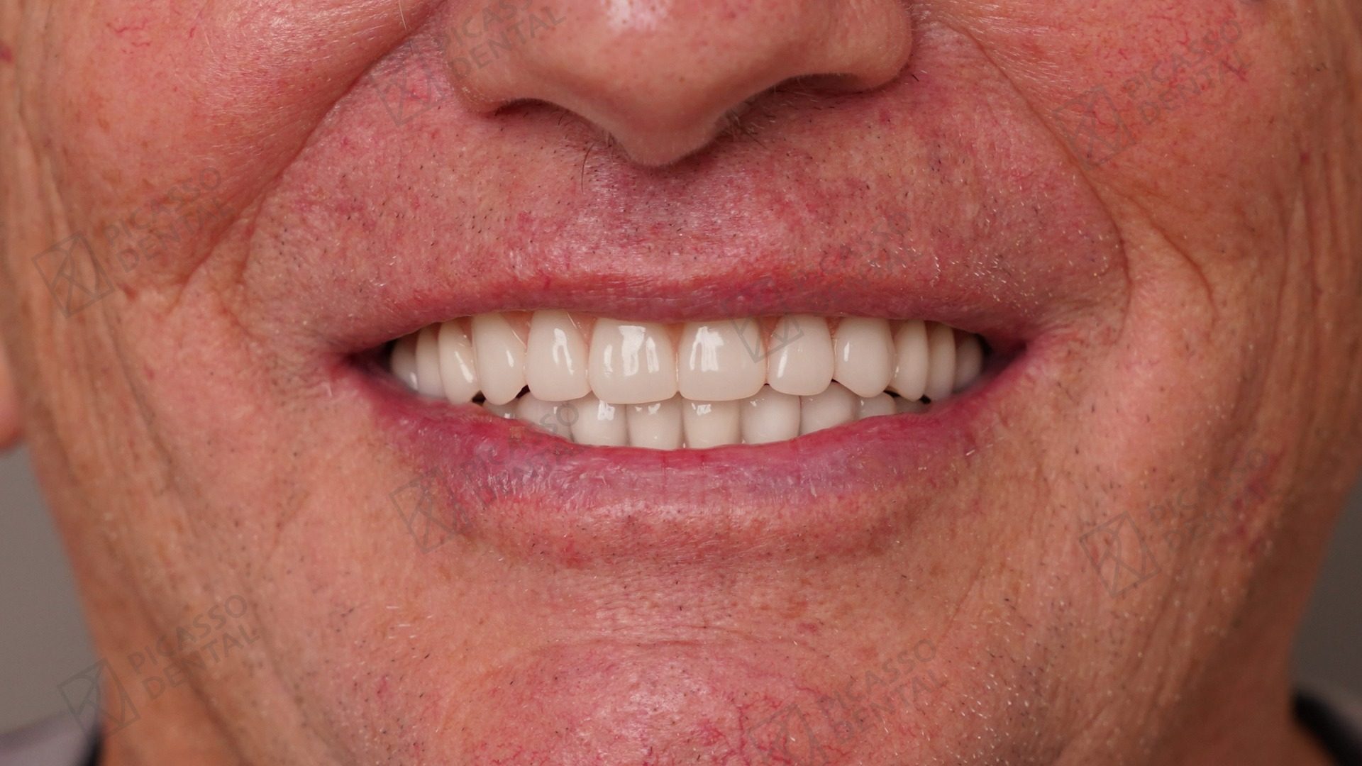 After: confident full smile restored with All-on-X implant-supported overdenture on a titanium bar with Lava zirconia crowns, Picasso Dental Thao Dien HCMC