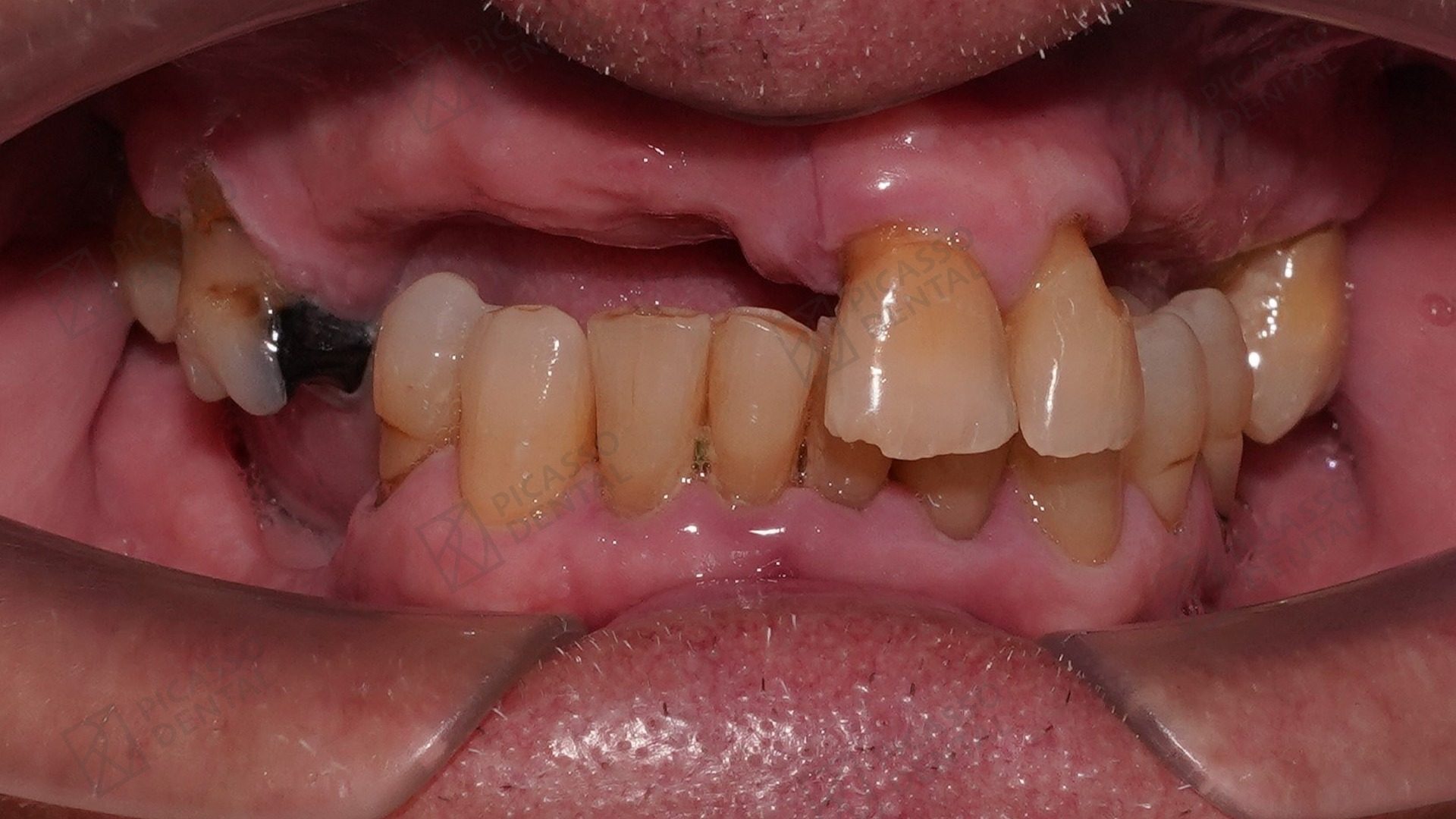 Before: collapsed upper arch with only stained, drifting teeth remaining in a 60s male patient prior to All-on-X overdenture rehabilitation at Picasso Dental