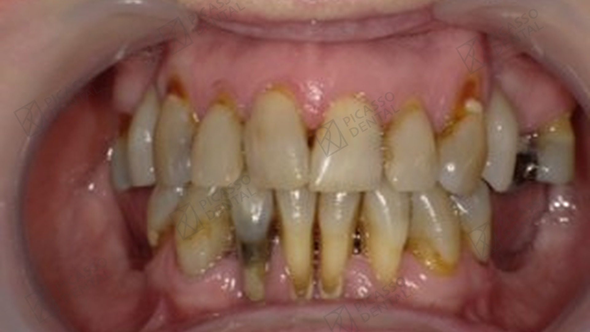Before: severe periodontal disease with mobile, stained and partially missing teeth in a 60s female patient prior to All-on-4 upper jaw rehabilitation at Picasso Dental