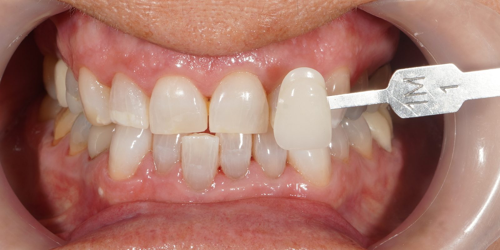 After: visibly brighter teeth following Picasso Glow laser whitening, Picasso Dental