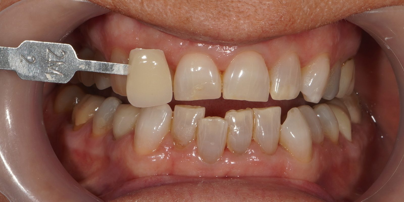 Before: discoloured teeth prior to Picasso Glow laser whitening at Picasso Dental