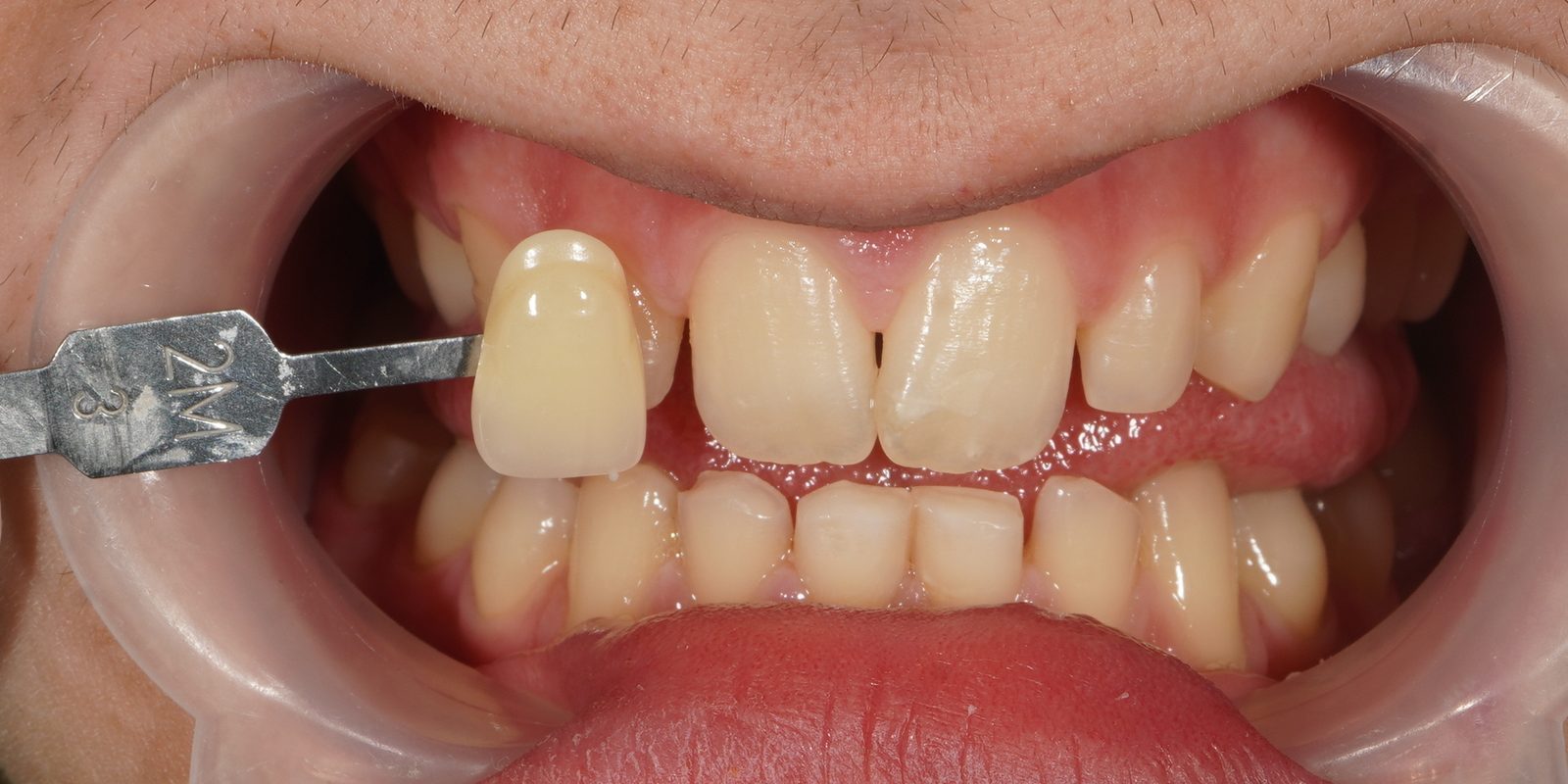 Before: yellowed teeth prior to Picasso Glow laser whitening at Picasso Dental