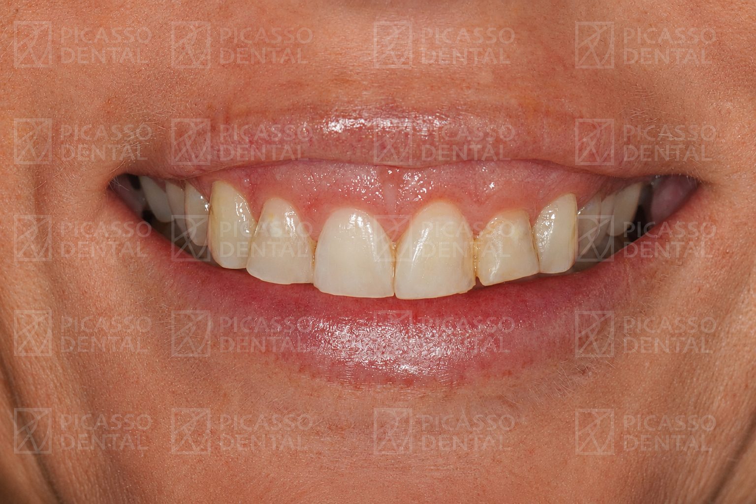Before: discoloured and uneven upper teeth prior to veneer treatment