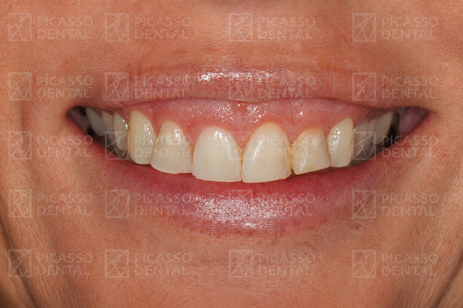 Before: discoloured and uneven upper teeth prior to veneer treatment