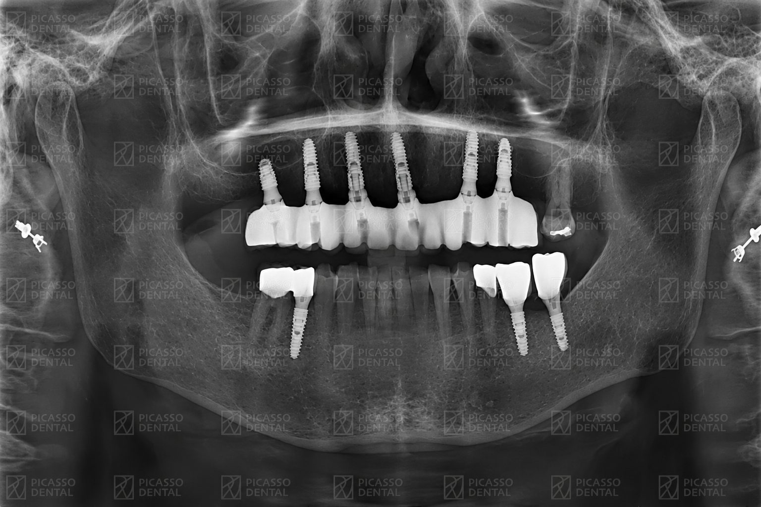 Panoramic CBCT X-ray of the same Picasso Dental patient after multi-implant placement, showing implants and connected fixed bridge