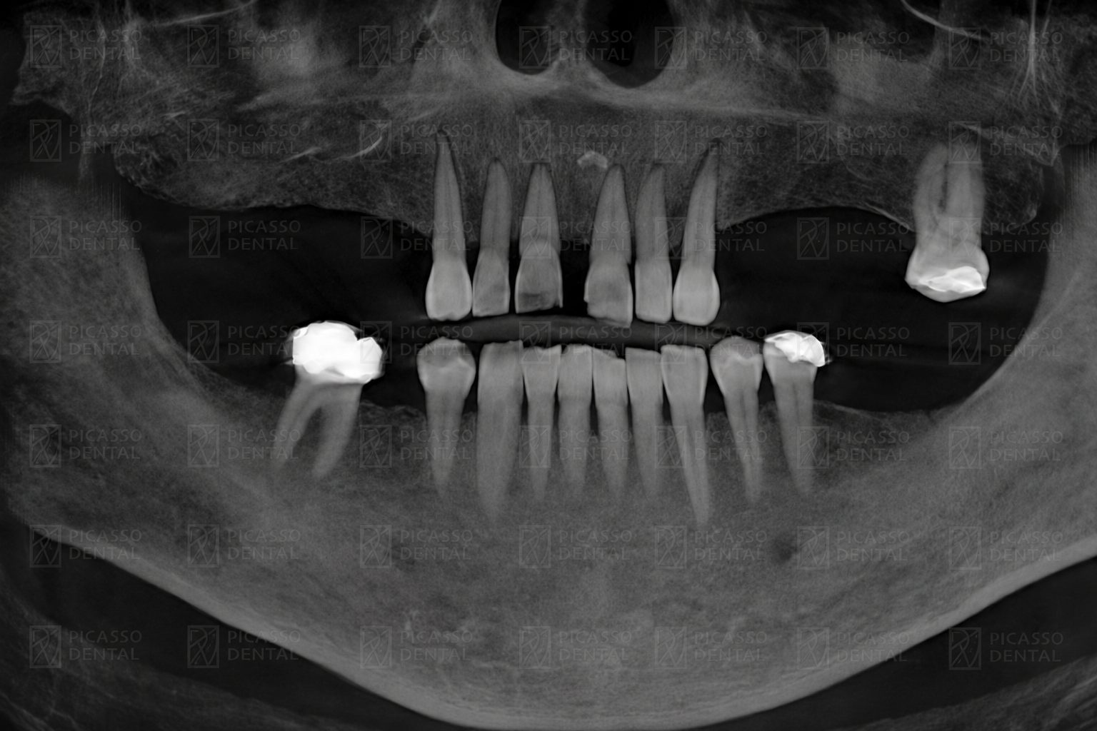 Panoramic CBCT X-ray of a Picasso Dental patient before multi-implant placement, showing failing posterior teeth