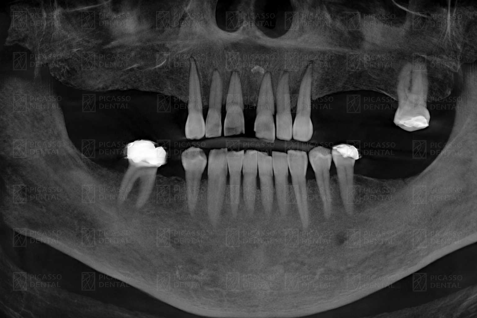 Panoramic CBCT X-ray of a Picasso Dental patient before All-on-4 implant placement, showing failing upper teeth