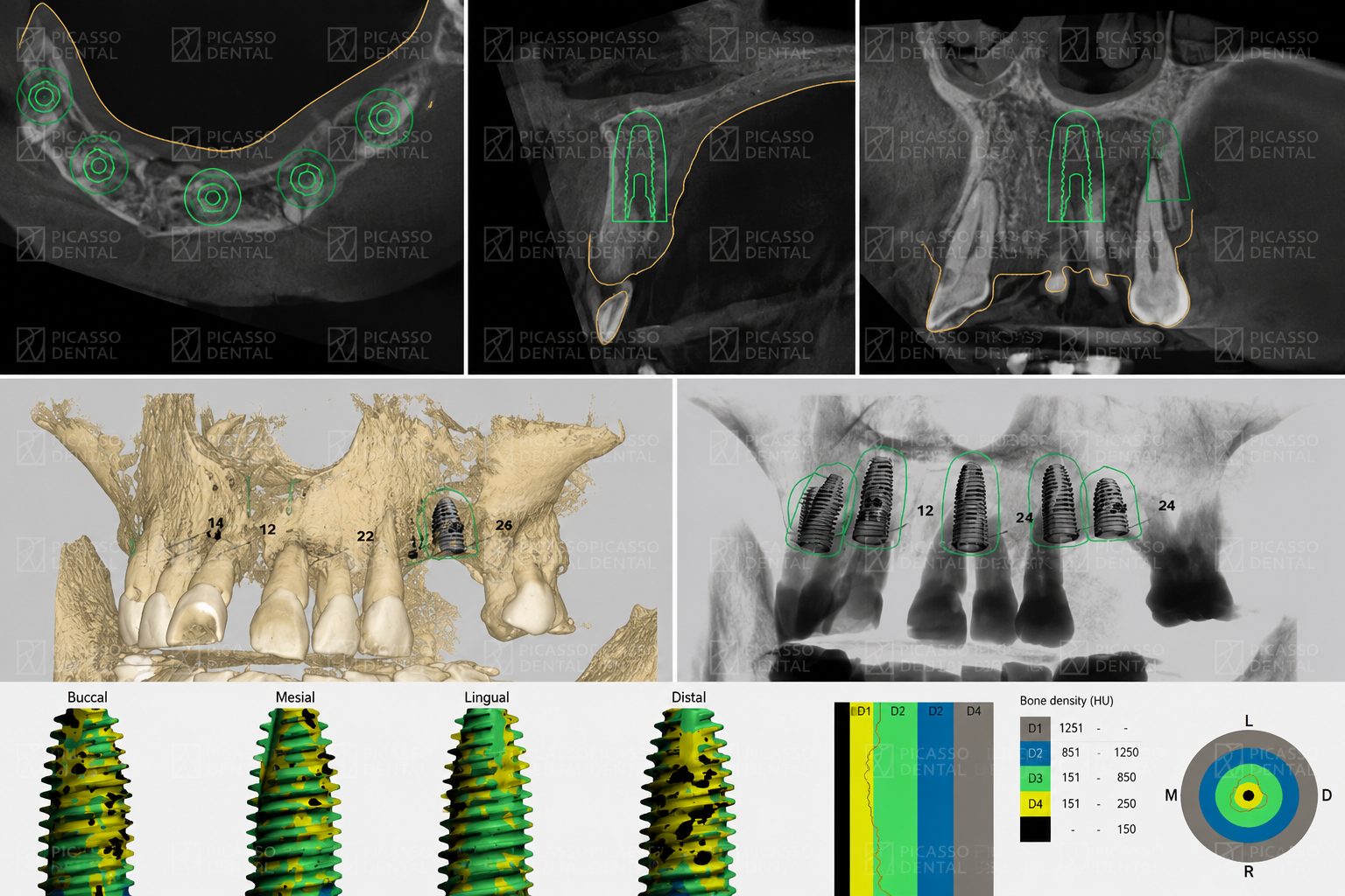 CBCT-guided implant bridge treatment planning at Picasso Dental, showing 3D bone density analysis, surgical guides and digital implant positioning